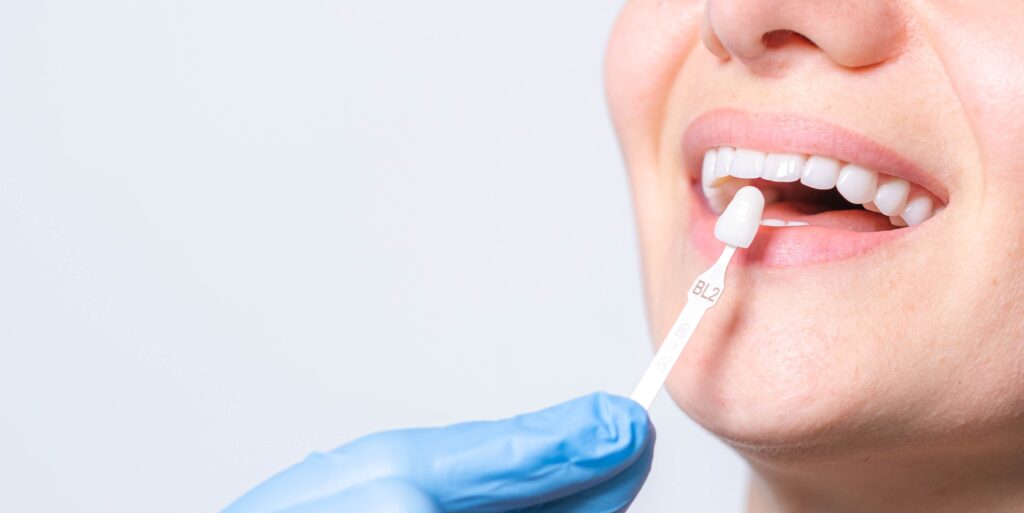 Dental Crowns in Novato—Achieve perfect white teeth with expert care and shade matching.